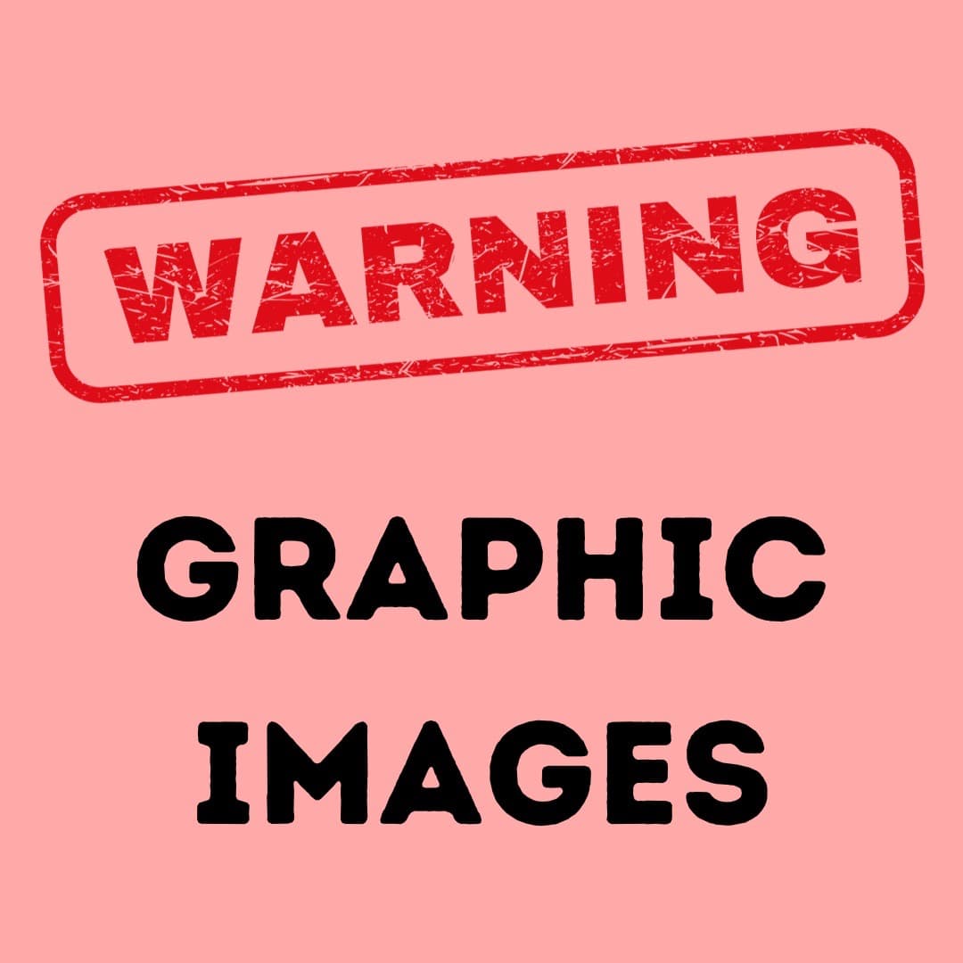 Warning! Graphic photo will be revealed when clicked.